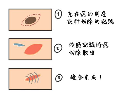 痣 凸起來|痣